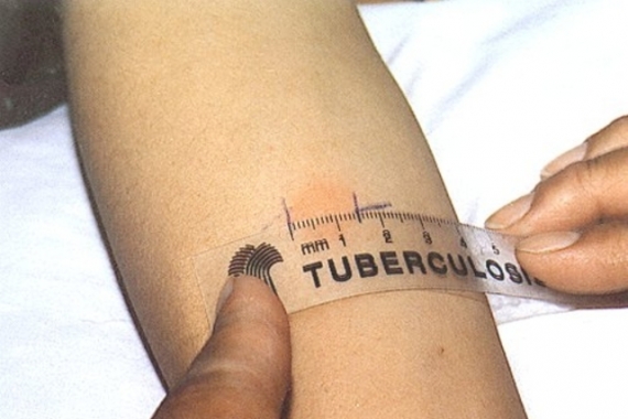  Natal possui cinco unidades de referência para testes de diagnóstico de tuberculose 